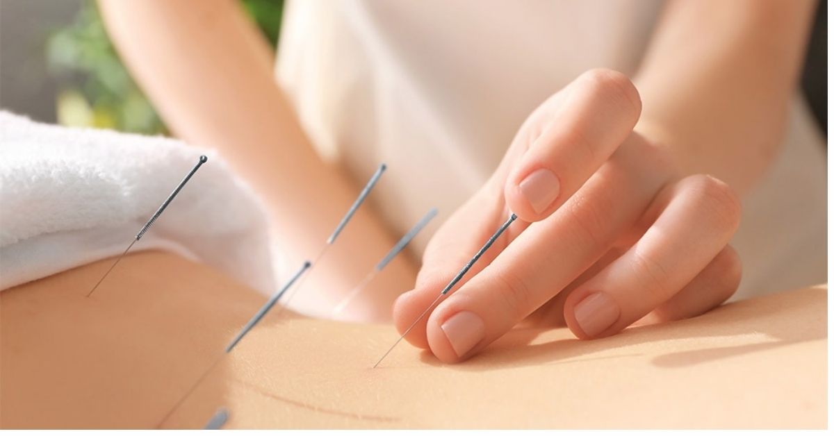 5 beneficios de la acupuntura para ti