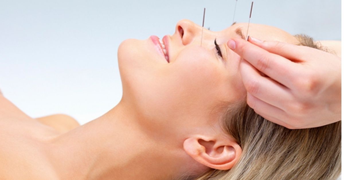 5 beneficios de la acupuntura para ti